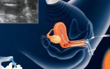 2026年拉拉去上海市东方医院做精子试管可以吗？大概要花多少钱？